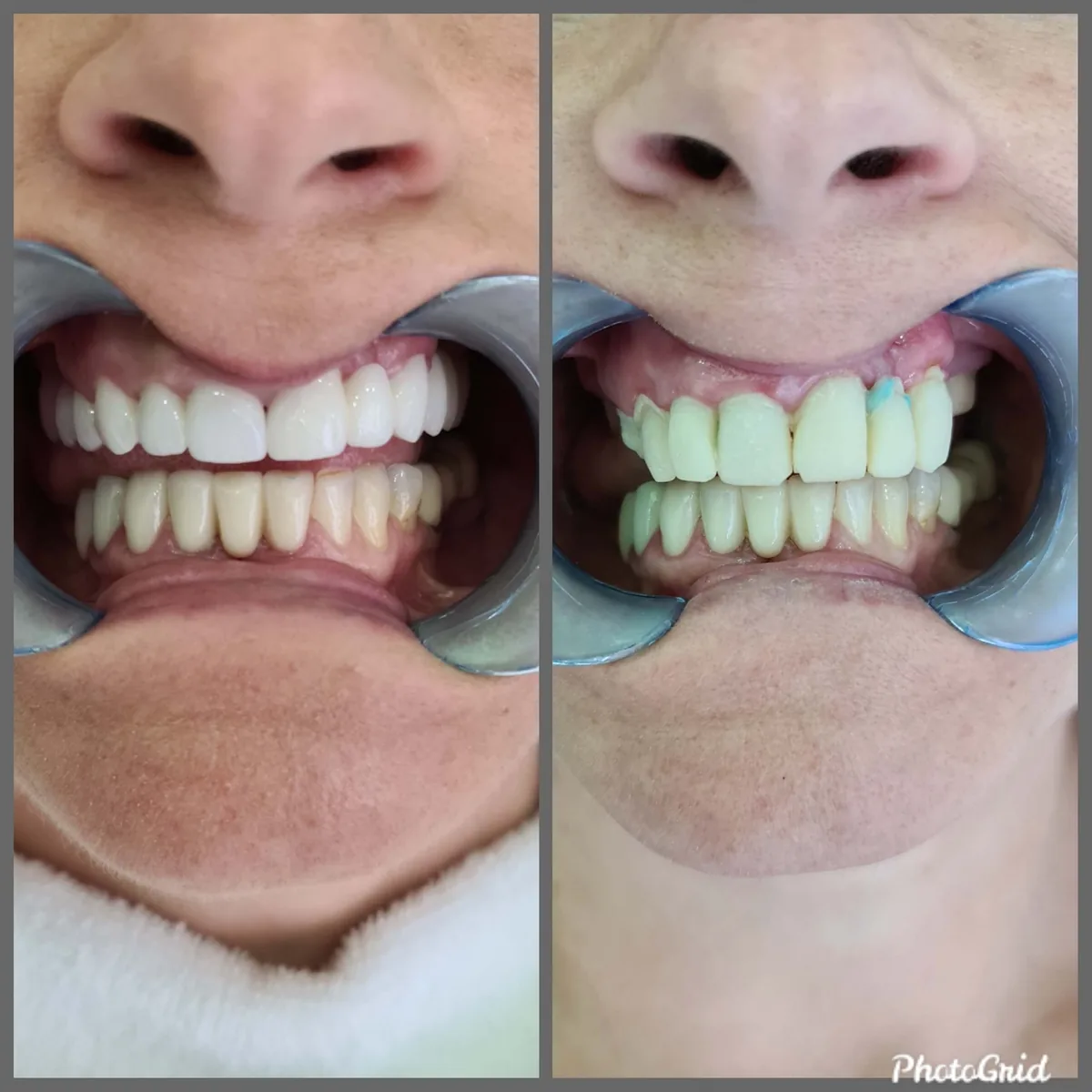 Realizzazione di corone in zirconio - prima e dopo