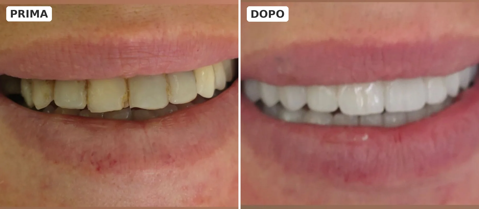 Prima e dopo una correzione estetica del sorriso - Elite Dent