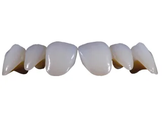 Ponte in ceramica di zirconio